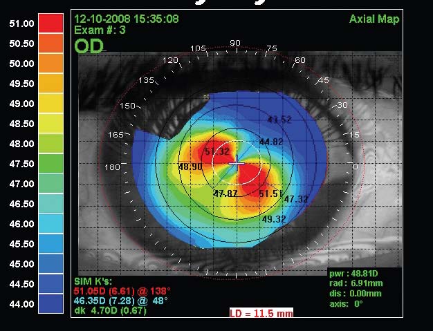 תמונה 5ב: טופוגרפיה של העין הימנית המדגימה קרטוקונוס. ניתן לראות שצורת הקרטוקונוס בעין זו מזכירה את התבנית הטופוגרפית בעין שמאל. תבנית ה- AB/SRAX נחשבת כמנבאת של קרטוקונוס מוקדם, בעיקר אם בעין השנייה קיים קרטוקונוס
