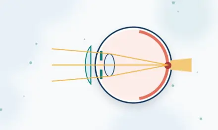 מחקר קליני: השתלה תוך-עינית של טלסקופ זעיר בחולי נמ"ג –  AMD