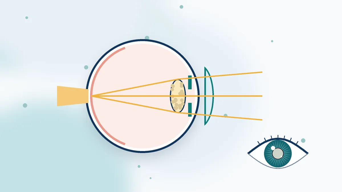 ניתוח קטרקט | cataract